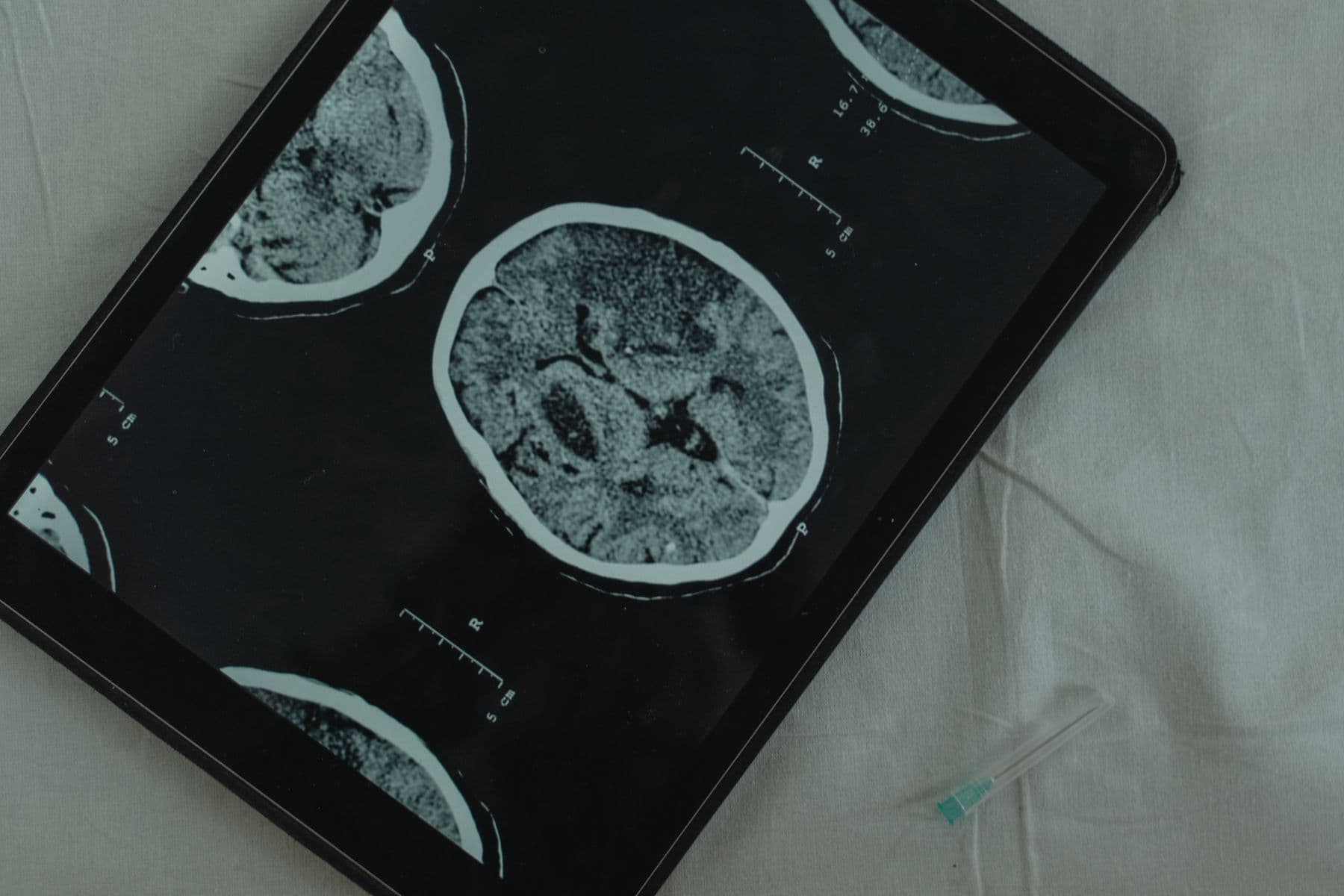A brain CT scan displayed on a tablet