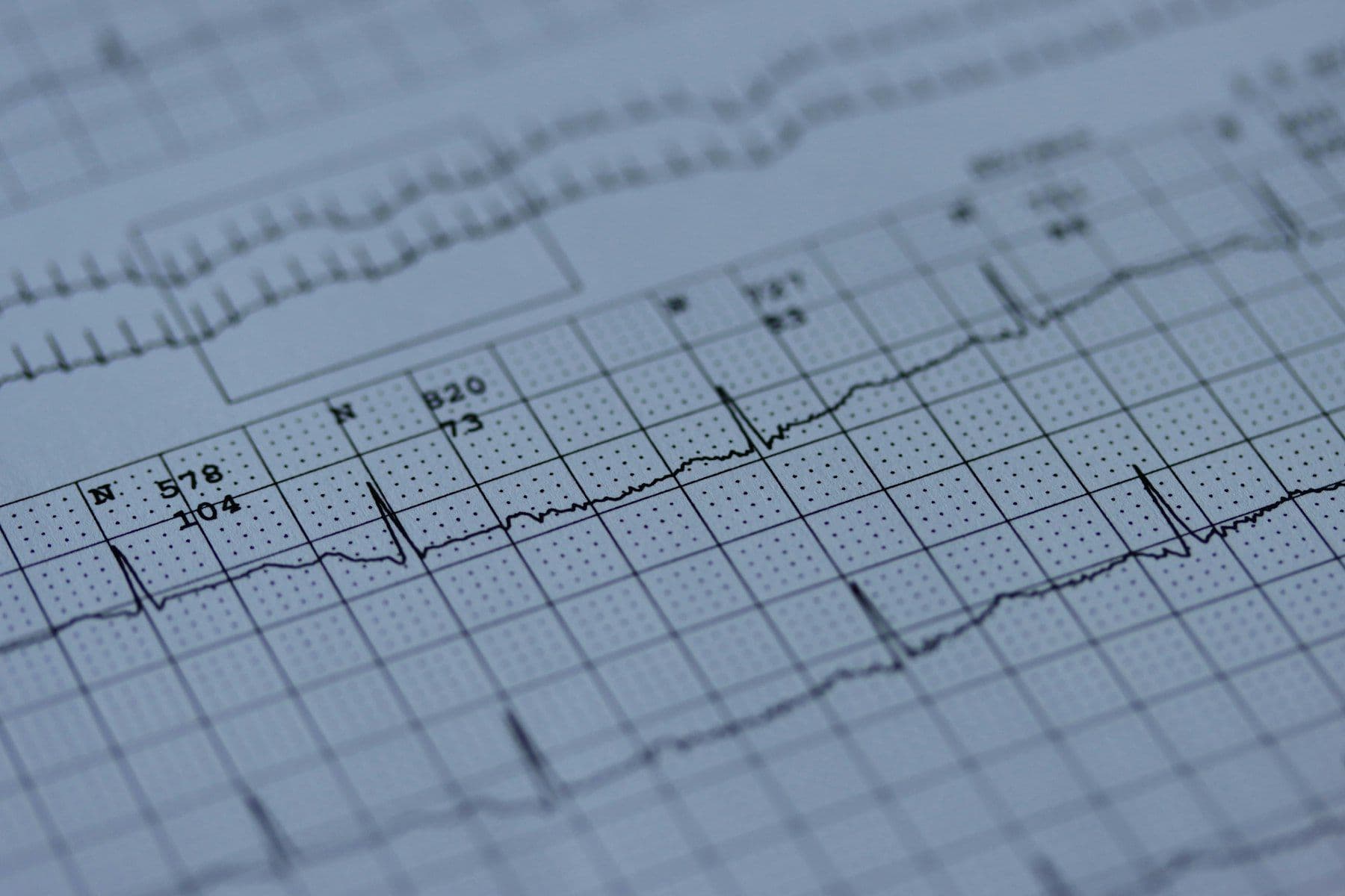An electrocardiogram printout on grid paper